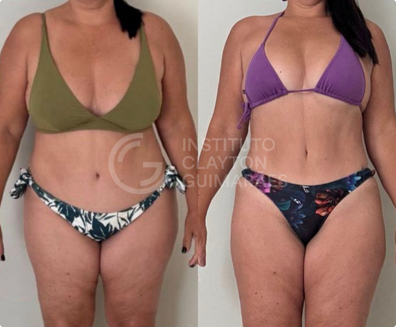 Antes e depois 5
