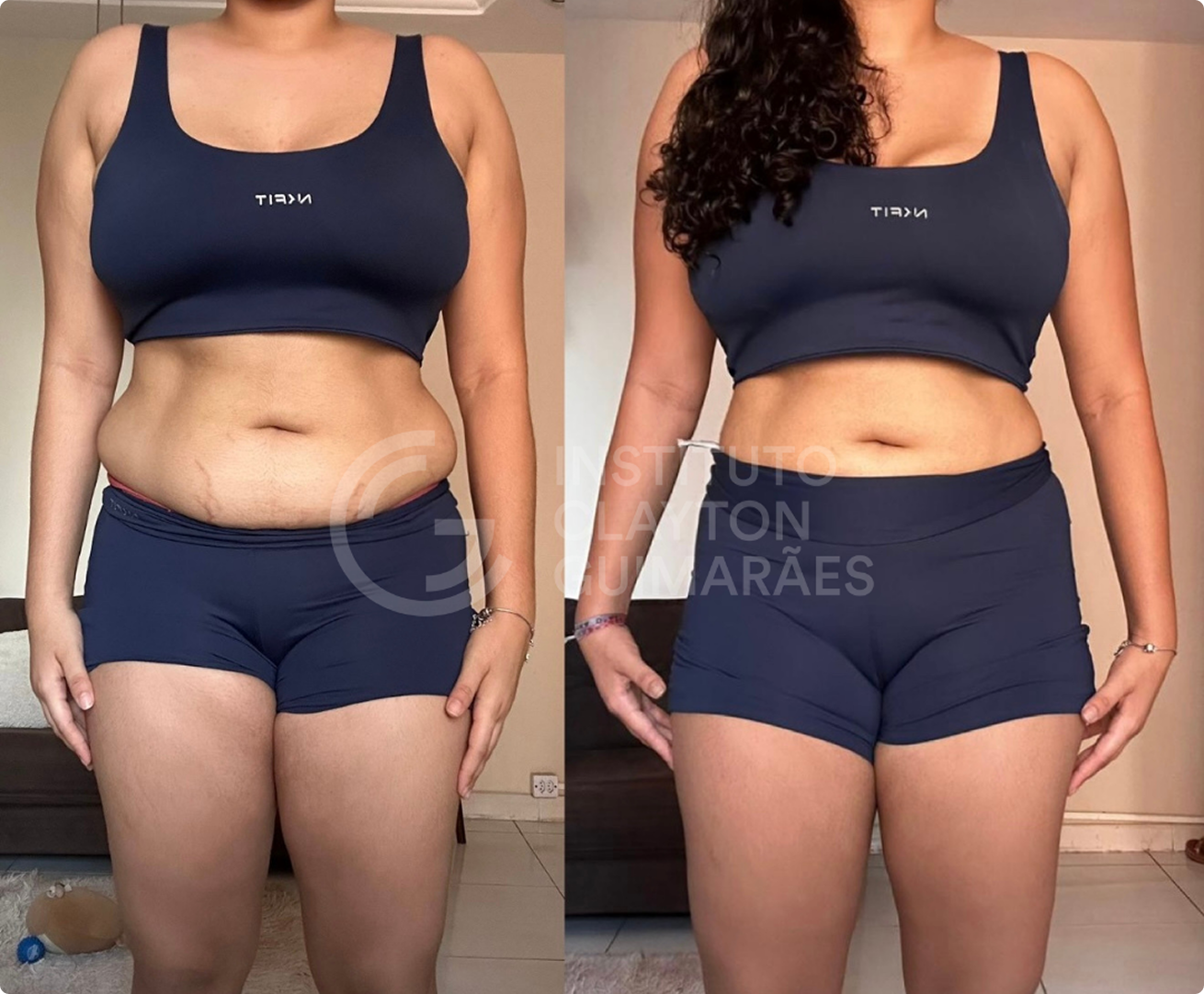 Antes e depois 1