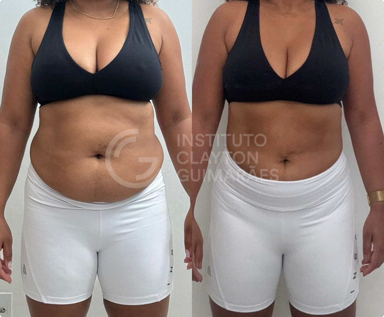 Antes e depois 3